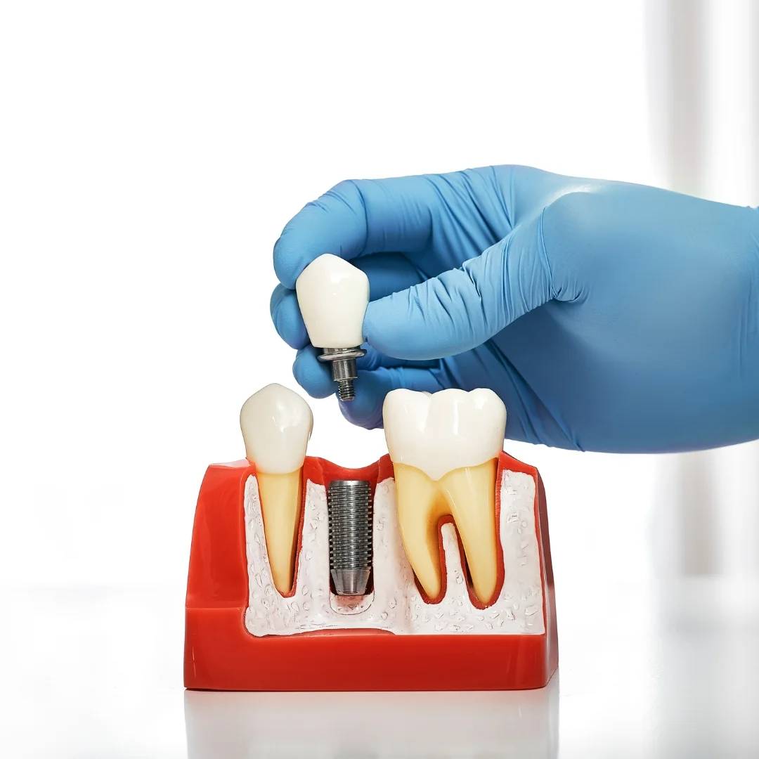 Implant Dentistry in Windsor, ON
